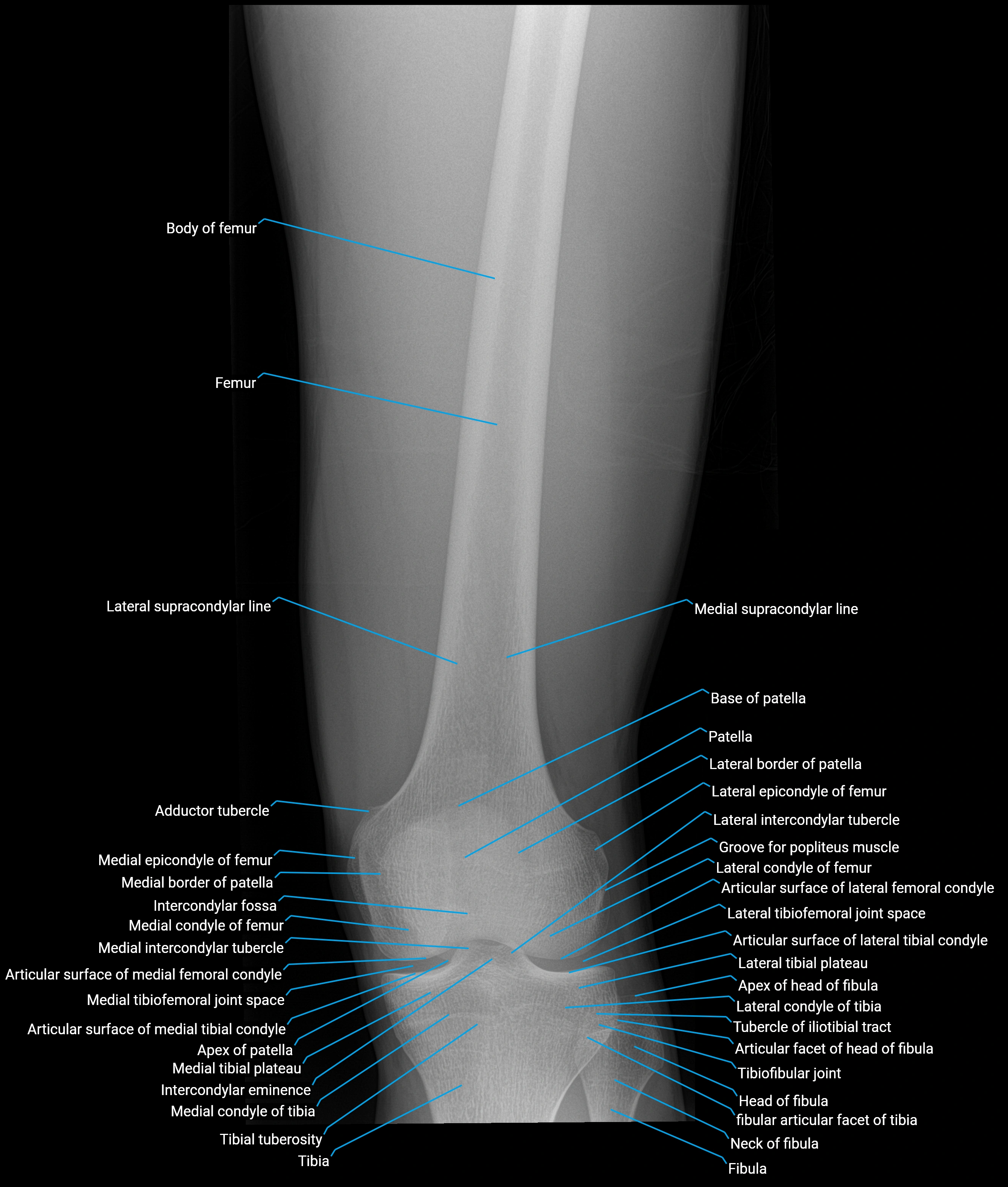 X ray femur AP  anatomy labelled image lower.webp